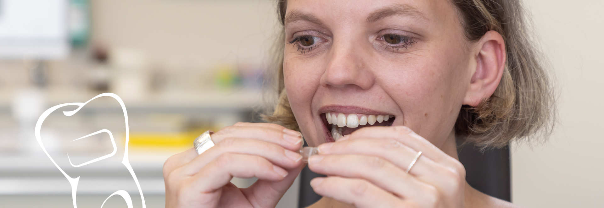 Frau setzt eine transparente Zahn-Schiene ein